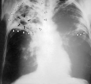 Image of patient with TB. Courtesy of CDC:PHIL